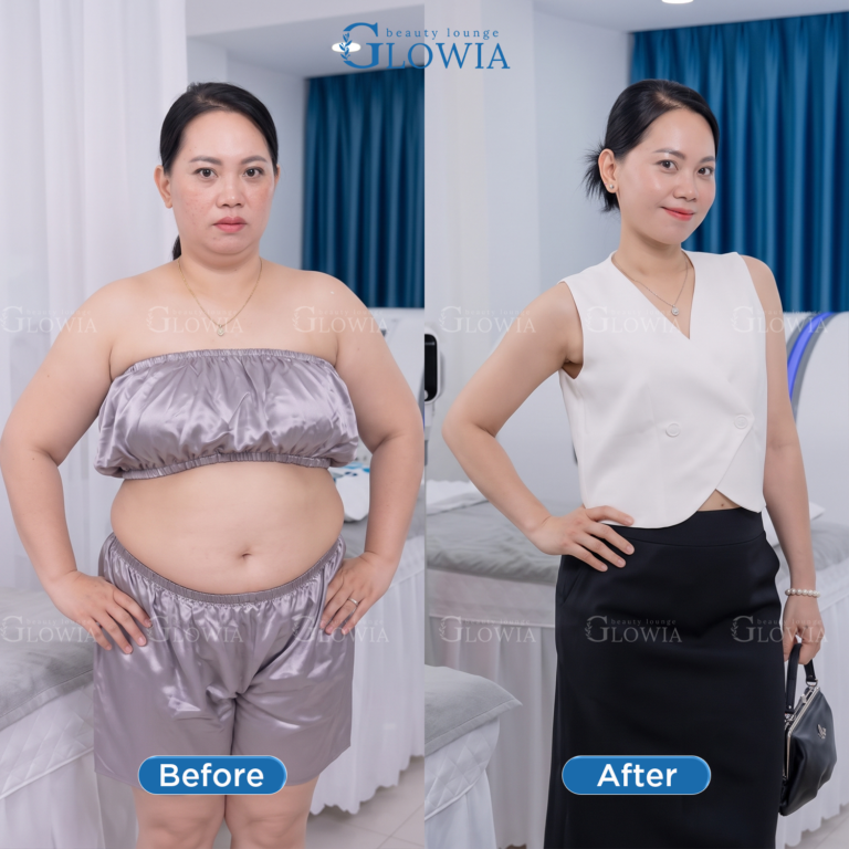 Before and after – MaxSlim Extra, After 1 treatment