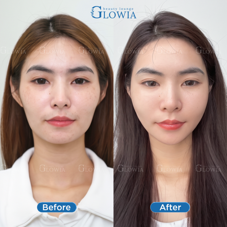 Before and after – Collagen NAD+, Full face combo