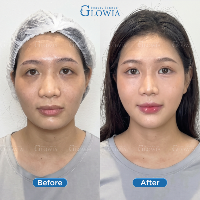Before and after – Collagen NAD+, Full face combo