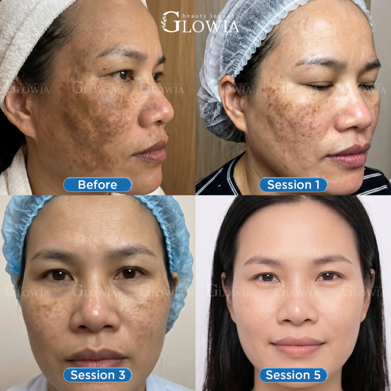 Before and after – Melasma Fusion, After 5 sessions