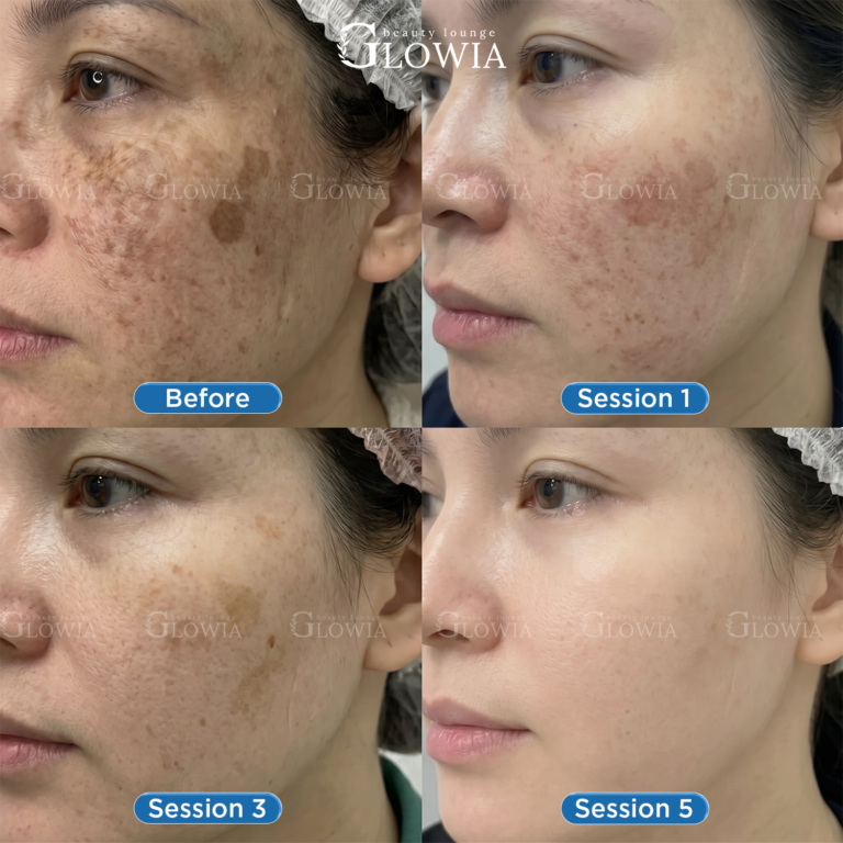 Before and after – Melasma Fusion, After 5 sessions