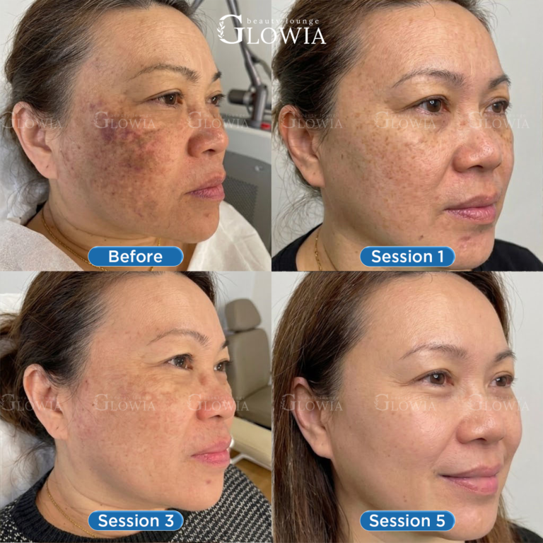 Before and after – Melasma Fusion, After 5 sessions