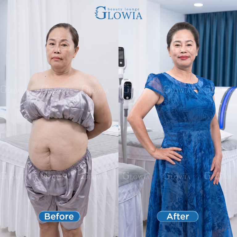 Before and after – MaxSlim Extra, After 1 treatment