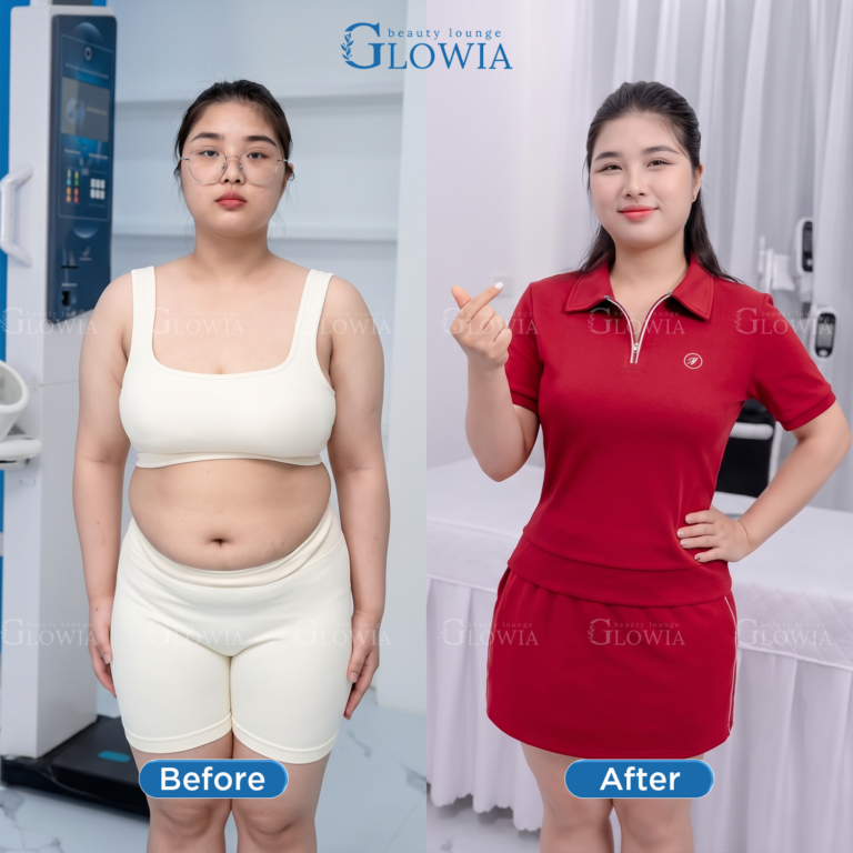 Before and after – MaxSlim Extra, After 1 treatment