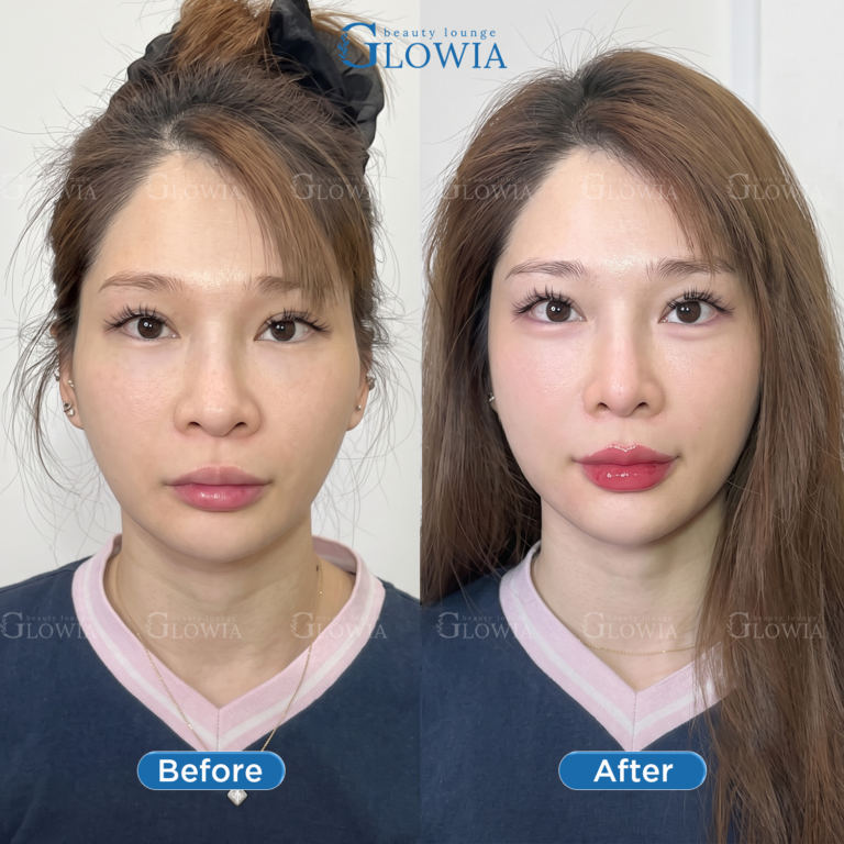 Before and after – Collagen NAD+, Full face combo